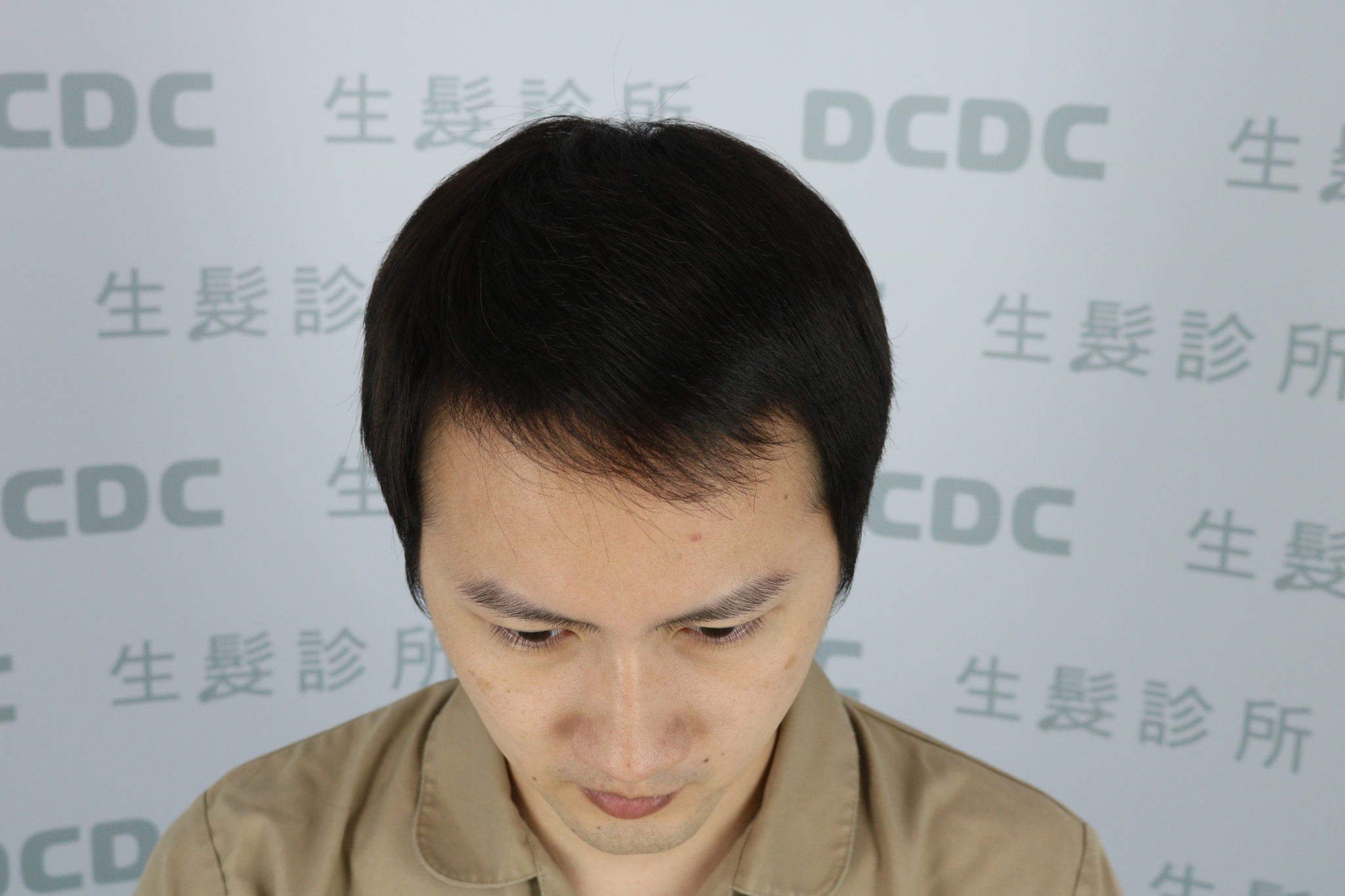 DCDC生髮診所-前額髮際線空洞與稀疏毛流術前細節記錄